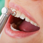 Professional dental cleaning