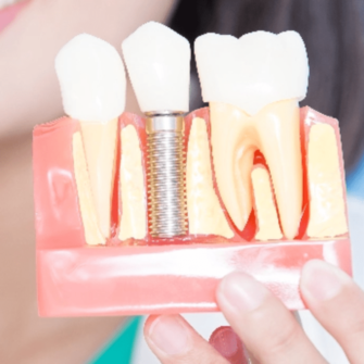 model of a dental implant