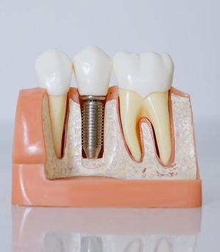 Dental Implant Crosssection Dental implant fixture