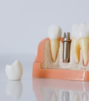Dental implant abutment Dental implant showing abutment