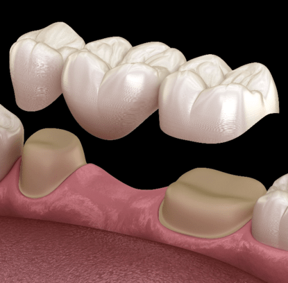 Dental Bridge
