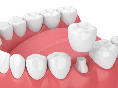 how a dental crown works