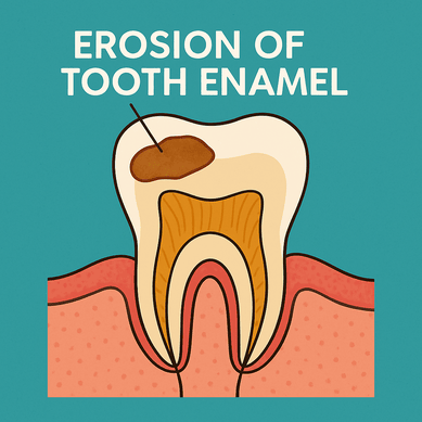 illustration of tooth enamel erosion