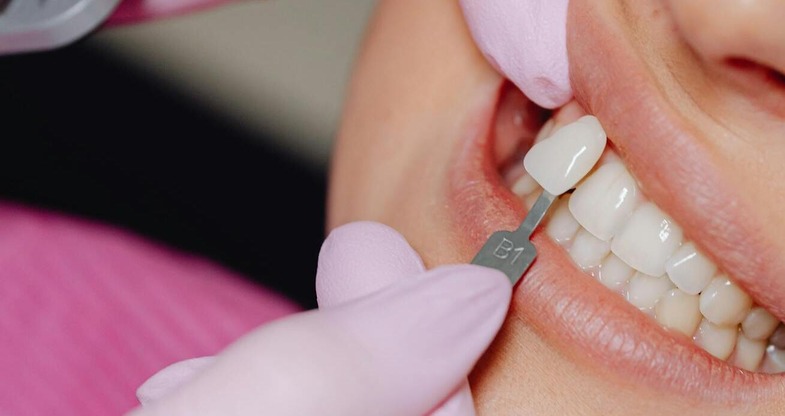 Dentist checking the colour match of a dental veneer